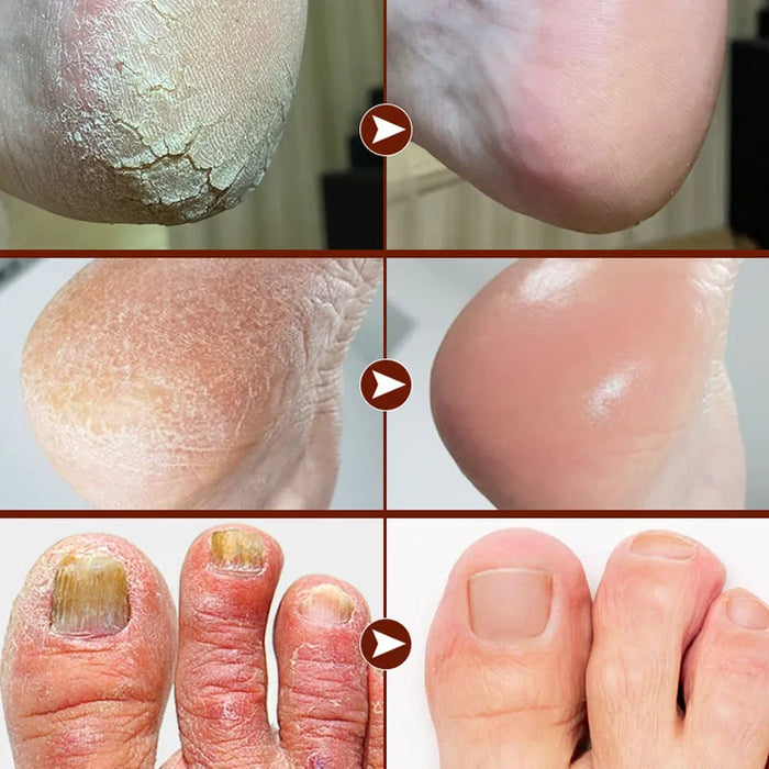 Anti Drying Feet Cream Heel Cracking Repair Products Exfoliation Dead Skin Removal Softening Moisturizing Hands Legs Care Beauty