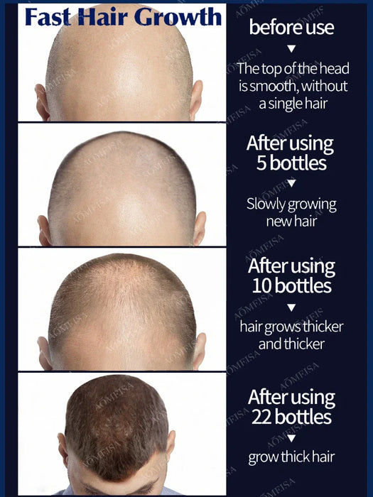 Hair growth products to quickly repair hair loss, hereditary hair loss, seborrheic alopecia