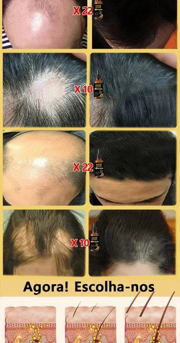 Fast Hair Growth Hair Growth Oil Effective Baldness Repair Hereditary Loss Postpartum  Loss Seborrheic Hair Anti Loss