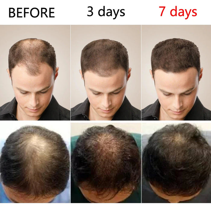 Hair Growth Oil Effective Baldness Repair Hereditary Postpartum Seborrheic Hair Loss for Women & Men Fast Hair Growth Oil