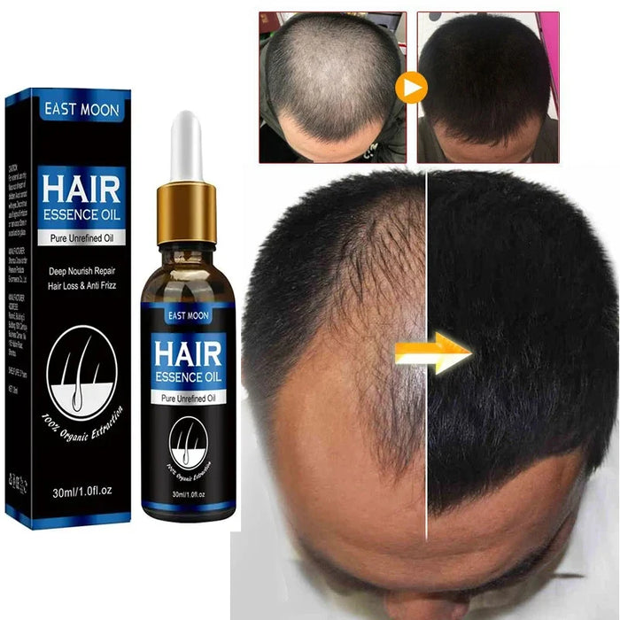 Hair Growth Oil Repair Hereditary Hair Loss Postpartum Hair Loss Follicle Seborrheic Hair Loss Fast Effective Repair Baldness