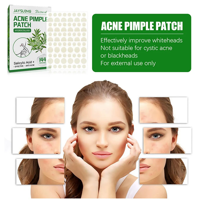 144Pcs Acne Pimple Patch Stickers Waterproof Acne Treatment Pimple Remover Tool Blemish Spot Facial Mask Skin Care