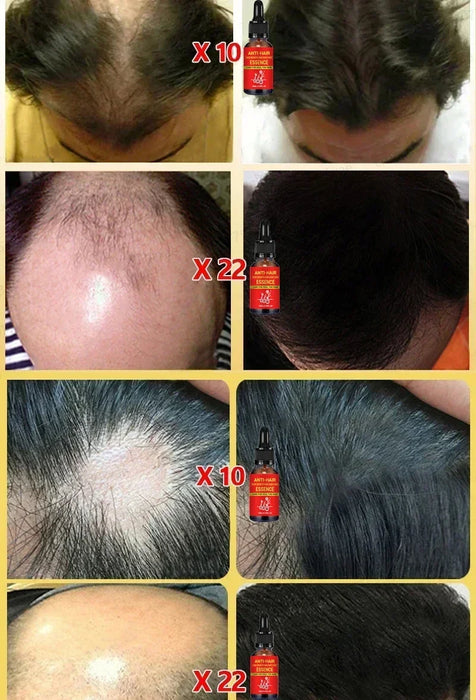 Fast Hair Growth Hair Growth Oil Effective Baldness Repair Hereditary Loss Postpartum  Loss Seborrheic Hair Anti Loss