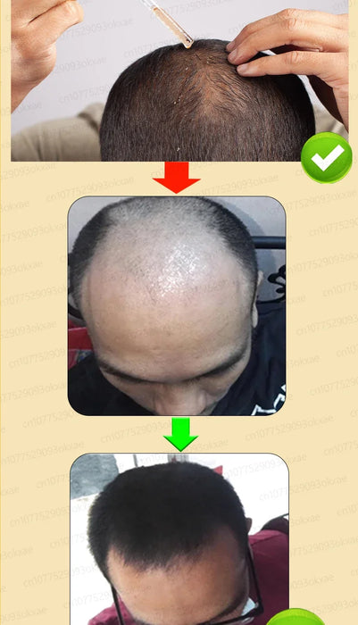 Unisex Growth Oil Hair Loss Treatment Rapid Hair Growth Effective Baldness Repair Hereditary Postpartum Hair Loss