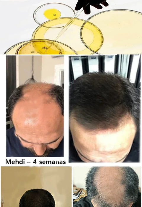 Fast Hair Growth Hair Growth Oil Effective Baldness Repair Hereditary Loss Postpartum  Loss Seborrheic Hair Anti Loss