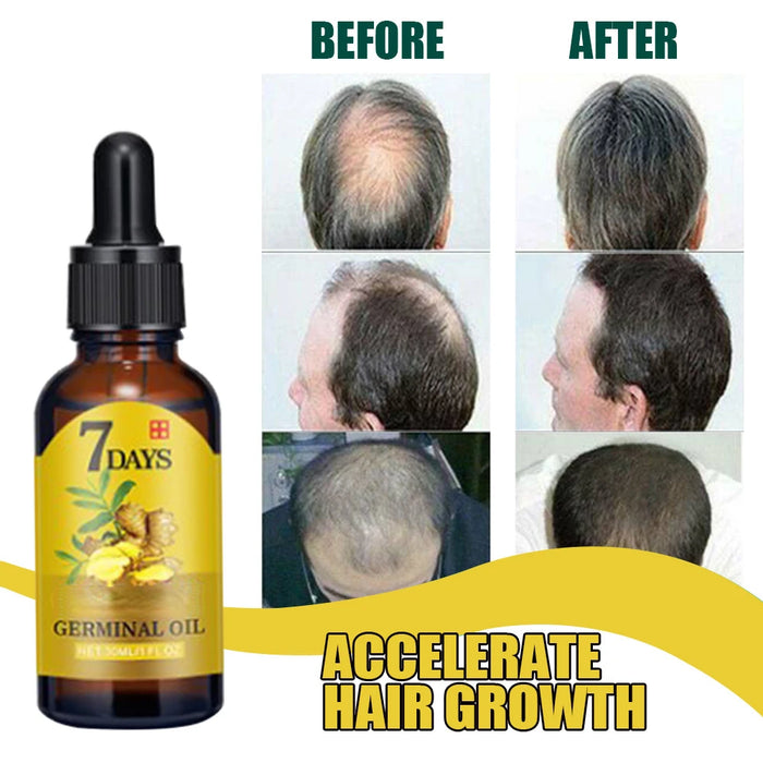 Fast Hair Growth Men Women Ginger Growth Hair Oil Treatment Anti Hair Loss Scalp Treatment Serum Products Beauty Healthwholesale