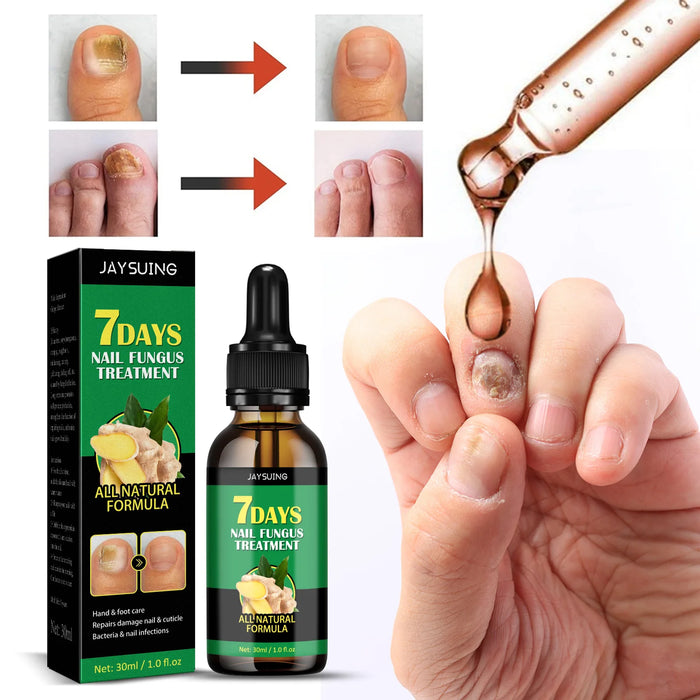 7DAYS Repair Nail Fungus Treatments Essence Foot Care Serum Toe Nails Fungal Removal Gel Anti-Infection Onychomycosis Care Tool