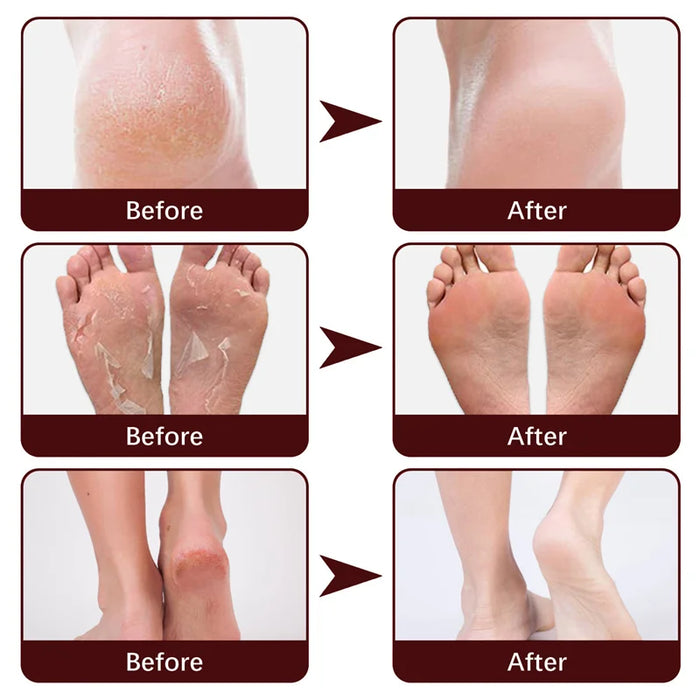 Anti Drying Feet Cream Heel Cracking Repair Products Exfoliation Dead Skin Removal Softening Moisturizing Hands Legs Care Beauty