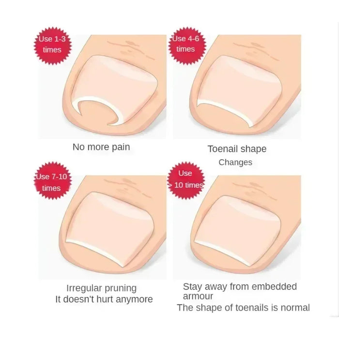 Ingrown Toenail Corrector Straightening Clip Pedicure Foot Nail Care Tools Stainless Steel Pedicure Treatment Onyxis Correction