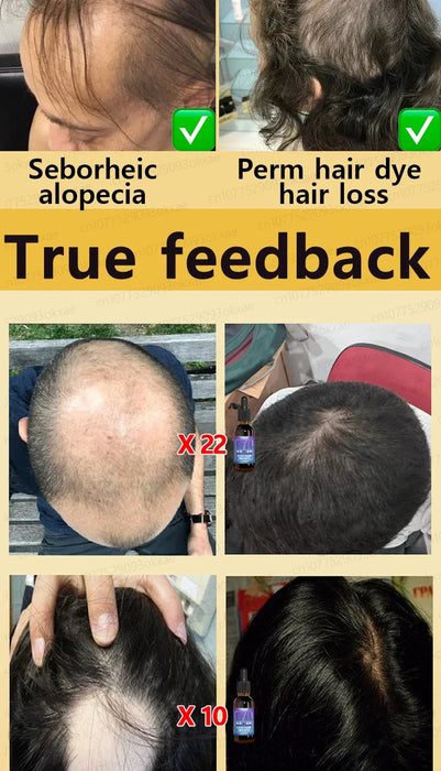 Unisex Growth Oil Hair Loss Treatment Rapid Hair Growth Effective Baldness Repair Hereditary Postpartum Hair Loss