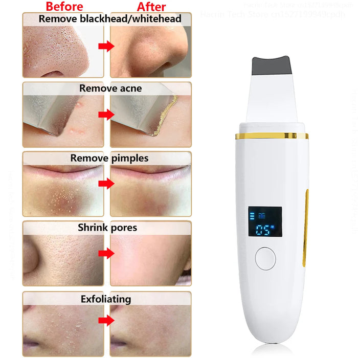 Ultrasonic Skin Scrubber Remover Blackhead Ultrasonic Peeling Facial Scrubber Shovel Deep Cleaning Face Lifting Remove Pore Acne